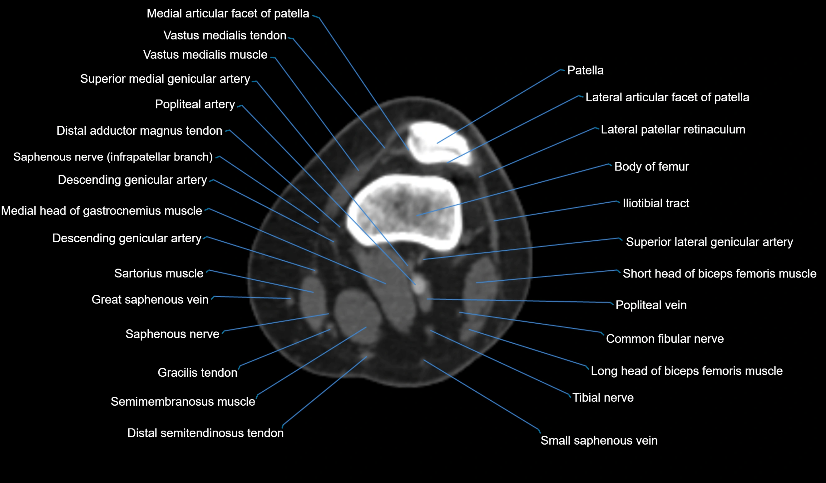 CT knee axial cross sectional anatomy labelled image-00020.webp